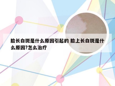 脸长白斑是什么原因引起的 脸上长白斑是什么原因?怎么治疗