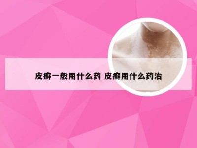 皮癣一般用什么药 皮癣用什么药治