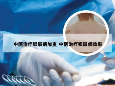 中医治疗银屑病加重 中医治疗银屑病效果