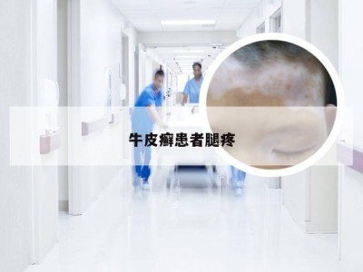 牛皮癣患者腿疼