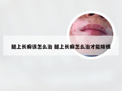 腿上长癣该怎么治 腿上长癣怎么治才能除根