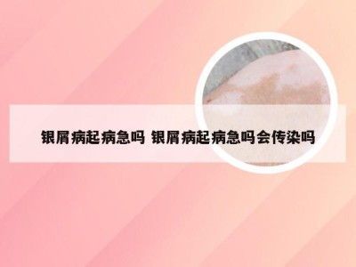 银屑病起病急吗 银屑病起病急吗会传染吗