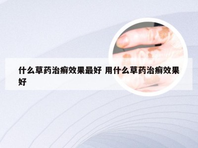 什么草药治癣效果最好 用什么草药治癣效果好