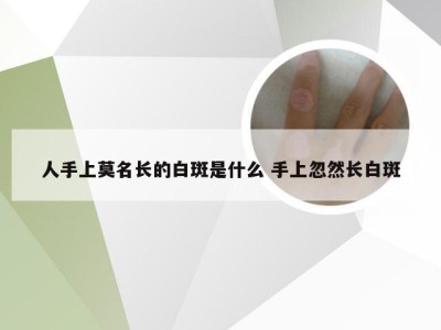 人手上莫名长的白斑是什么 手上忽然长白斑