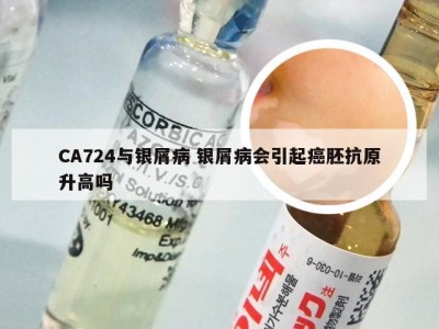 CA724与银屑病 银屑病会引起癌胚抗原升高吗