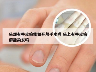 头部有牛皮癣能做开颅手术吗 头上有牛皮病癣能染发吗