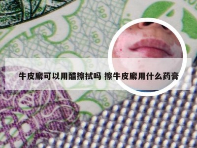 牛皮廨可以用醋擦拭吗 擦牛皮廨用什么药膏