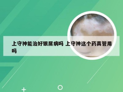 上守神能治好银屑病吗 上守神这个药真管用吗