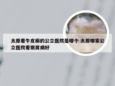 太原看牛皮癣的公立医院是哪个 太原哪家公立医院看银屑病好