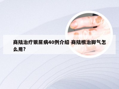 商陆治疗银屑病40例介绍 商陆根治脚气怎么用?