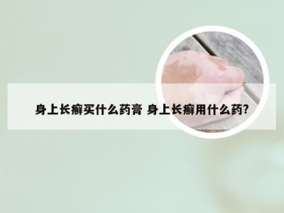 身上长癣买什么药膏 身上长癣用什么药?