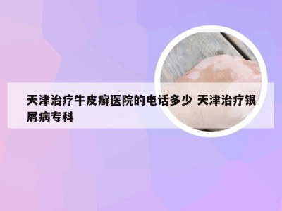 天津治疗牛皮癣医院的电话多少 天津治疗银屑病专科