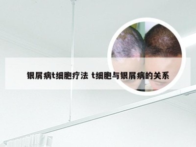 银屑病t细胞疗法 t细胞与银屑病的关系