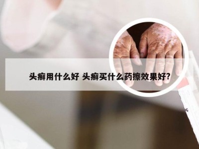 头癣用什么好 头癣买什么药擦效果好?