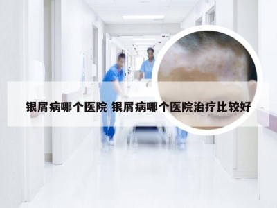 银屑病哪个医院 银屑病哪个医院治疗比较好