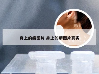 身上的癣图片 身上的癣图片真实