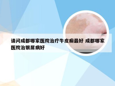 请问成都哪家医院治疗牛皮癣最好 成都哪家医院治银屑病好