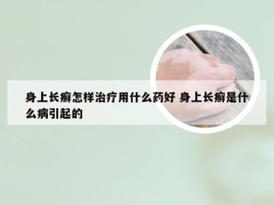 身上长癣怎样治疗用什么药好 身上长癣是什么病引起的