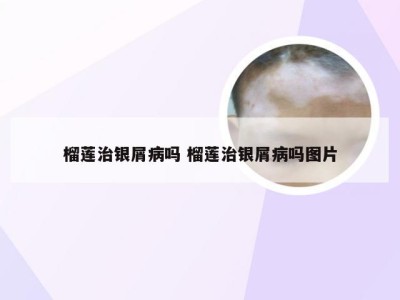 榴莲治银屑病吗 榴莲治银屑病吗图片