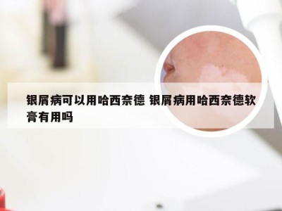 银屑病可以用哈西奈德 银屑病用哈西奈德软膏有用吗