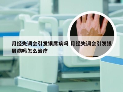 月经失调会引发银屑病吗 月经失调会引发银屑病吗怎么治疗