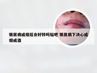 银屑病戒烟后会好转吗贴吧 银屑病下决心戒烟戒酒