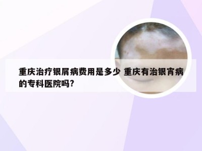 重庆治疗银屑病费用是多少 重庆有治银宵病的专科医院吗?