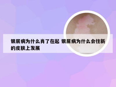 银屑病为什么肖了在起 银屑病为什么会往新的皮肤上发展