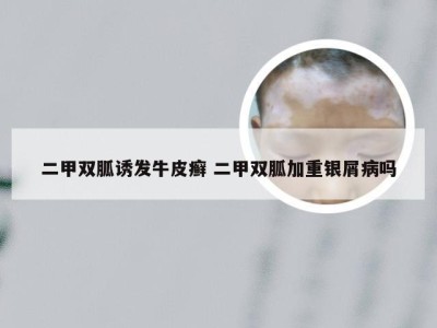 二甲双胍诱发牛皮癣 二甲双胍加重银屑病吗