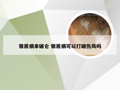 银屑病拿破仑 银屑病可以打破伤风吗