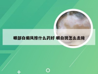 眼部白癜风擦什么药好 眼白斑怎么去除