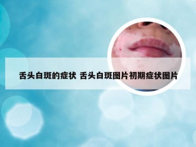 舌头白斑的症状 舌头白斑图片初期症状图片