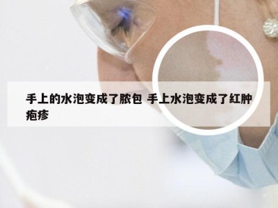 手上的水泡变成了脓包 手上水泡变成了红肿疱疹