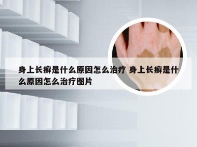 身上长癣是什么原因怎么治疗 身上长癣是什么原因怎么治疗图片