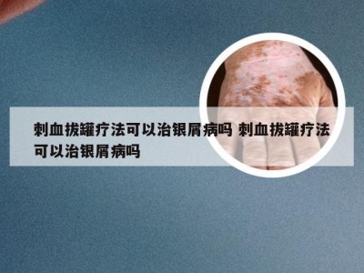 刺血拔罐疗法可以治银屑病吗 刺血拔罐疗法可以治银屑病吗