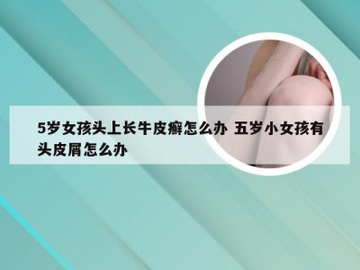 5岁女孩头上长牛皮癣怎么办 五岁小女孩有头皮屑怎么办