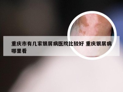 重庆市有几家银屑病医院比较好 重庆银屑病哪里看