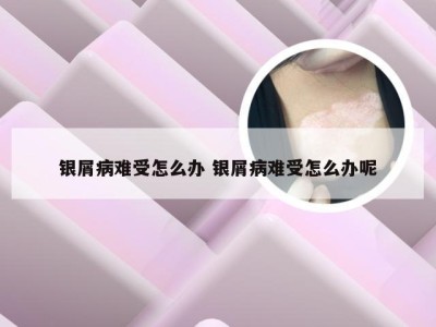 银屑病难受怎么办 银屑病难受怎么办呢