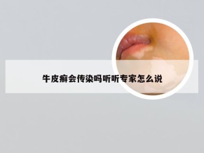 牛皮癣会传染吗听听专家怎么说