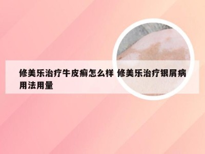 修美乐治疗牛皮癣怎么样 修美乐治疗银屑病用法用量