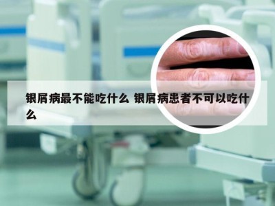 银屑病最不能吃什么 银屑病患者不可以吃什么