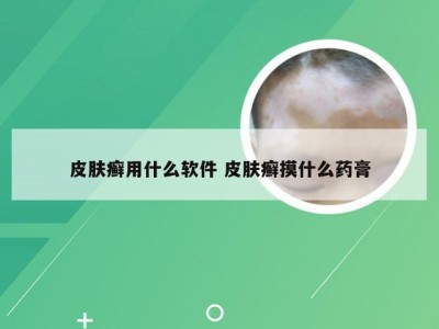 皮肤癣用什么软件 皮肤癣摸什么药膏