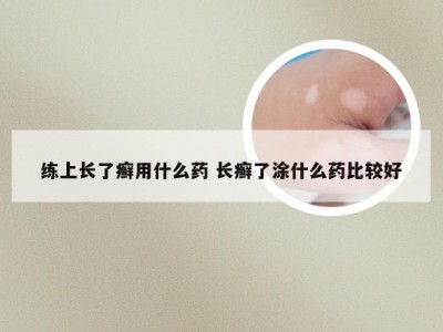 练上长了癣用什么药 长癣了涂什么药比较好