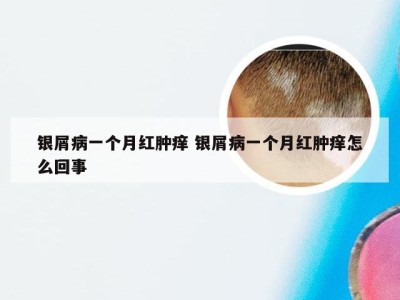 银屑病一个月红肿痒 银屑病一个月红肿痒怎么回事