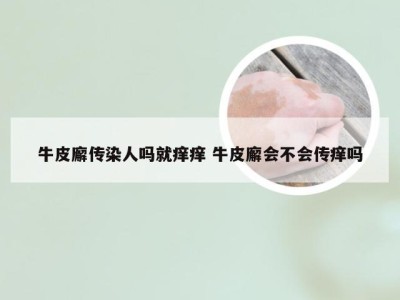 牛皮廨传染人吗就痒痒 牛皮廨会不会传痒吗