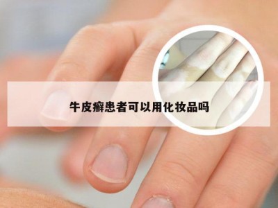 牛皮癣患者可以用化妆品吗