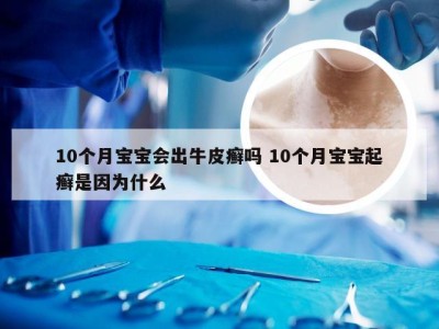 10个月宝宝会出牛皮癣吗 10个月宝宝起癣是因为什么