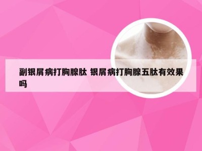 副银屑病打胸腺肽 银屑病打胸腺五肽有效果吗