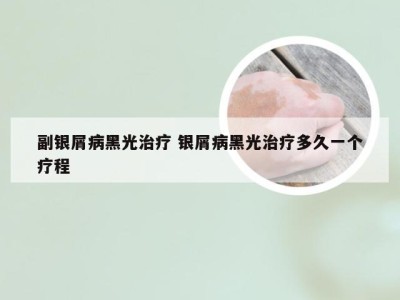 副银屑病黑光治疗 银屑病黑光治疗多久一个疗程