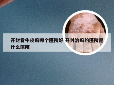 开封看牛皮癣哪个医院好 开封治癣的医院是什么医院